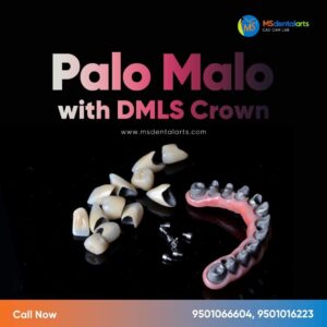 Palo Malo with DMLS Crown
